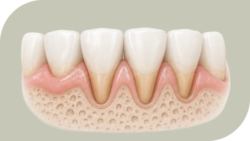 Déchaussement dentaire, une pathologie des gencives à traiter, dentiste Douai