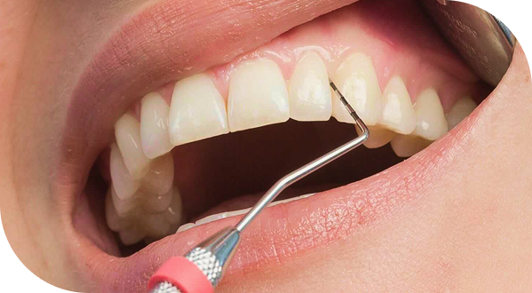 Application d’un éclaircissement dentaire à la lampe, dentiste Douai