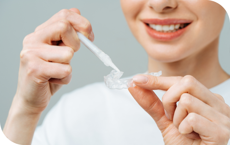 Blanchiment dentaire pour éclaircir la teinte des dents, dentiste Douai
