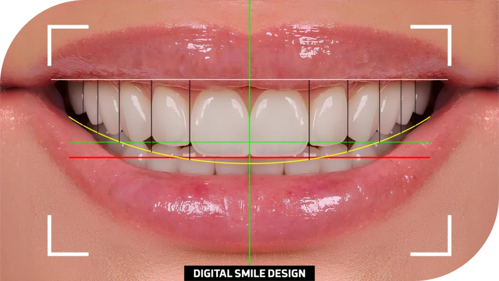 Smile Design