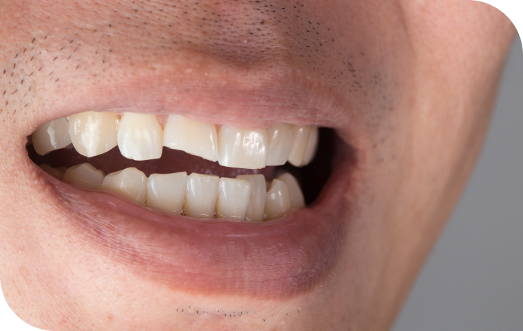 Dent cassée nécessitant une consultation d'urgence, dentiste Douai