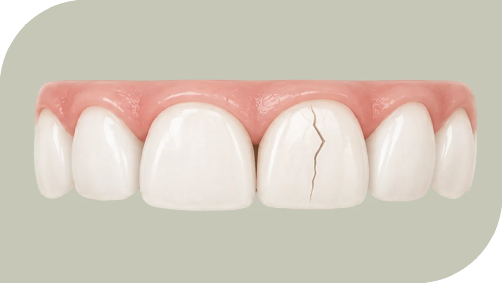 Dent fissurée avec une fêlure visible sur l'émail, dentiste Douai