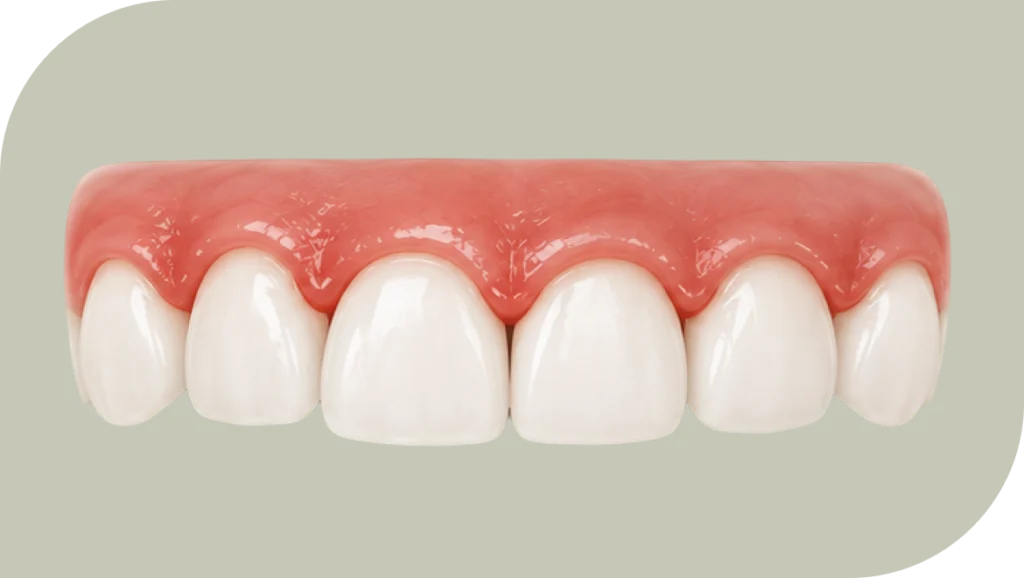 Gingivite : prendre rendez-vous pour traiter les gencives, dentiste Douai